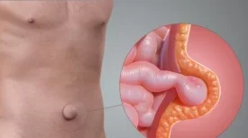 الفتق الاربي